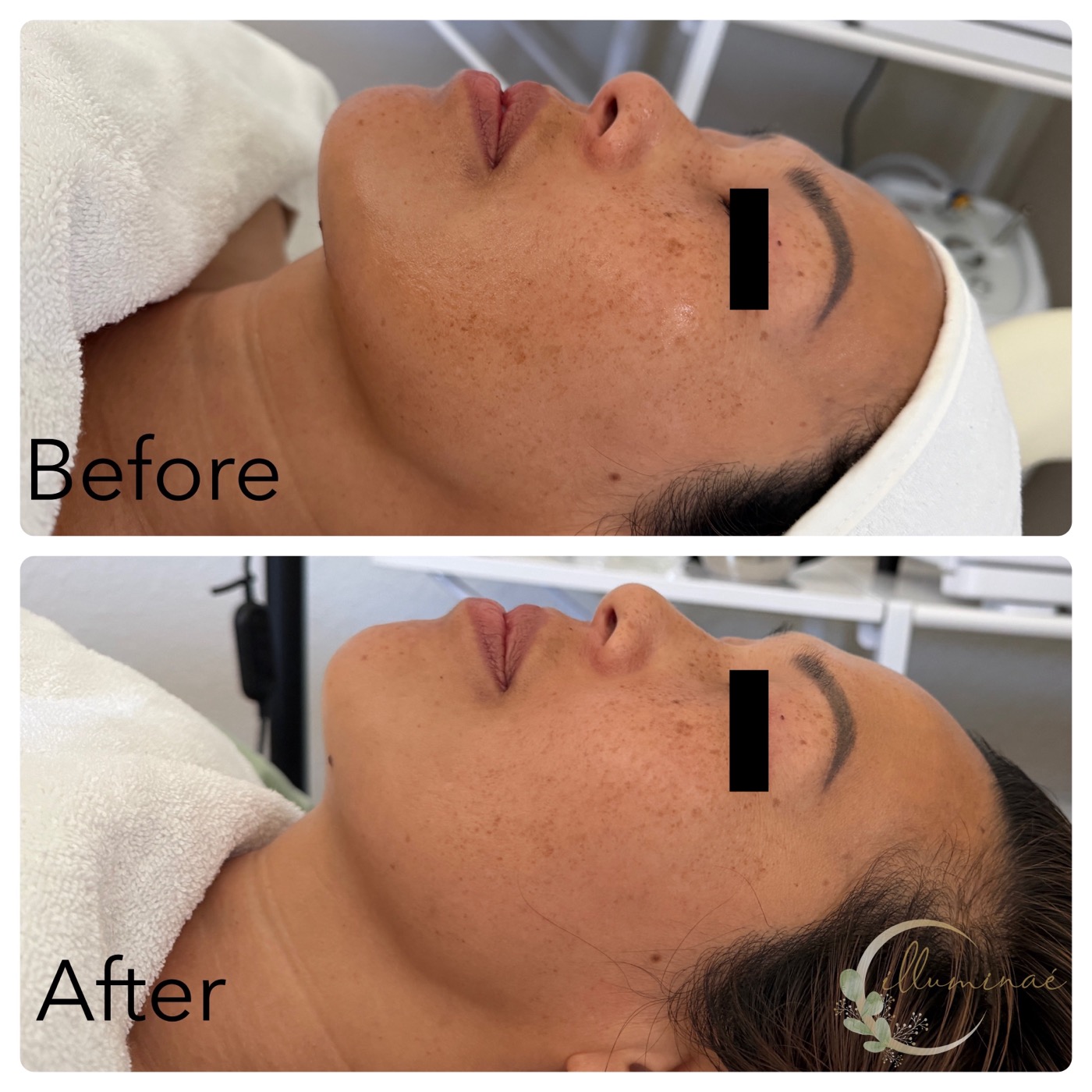 Before and after: pigmentation and freckle reduction