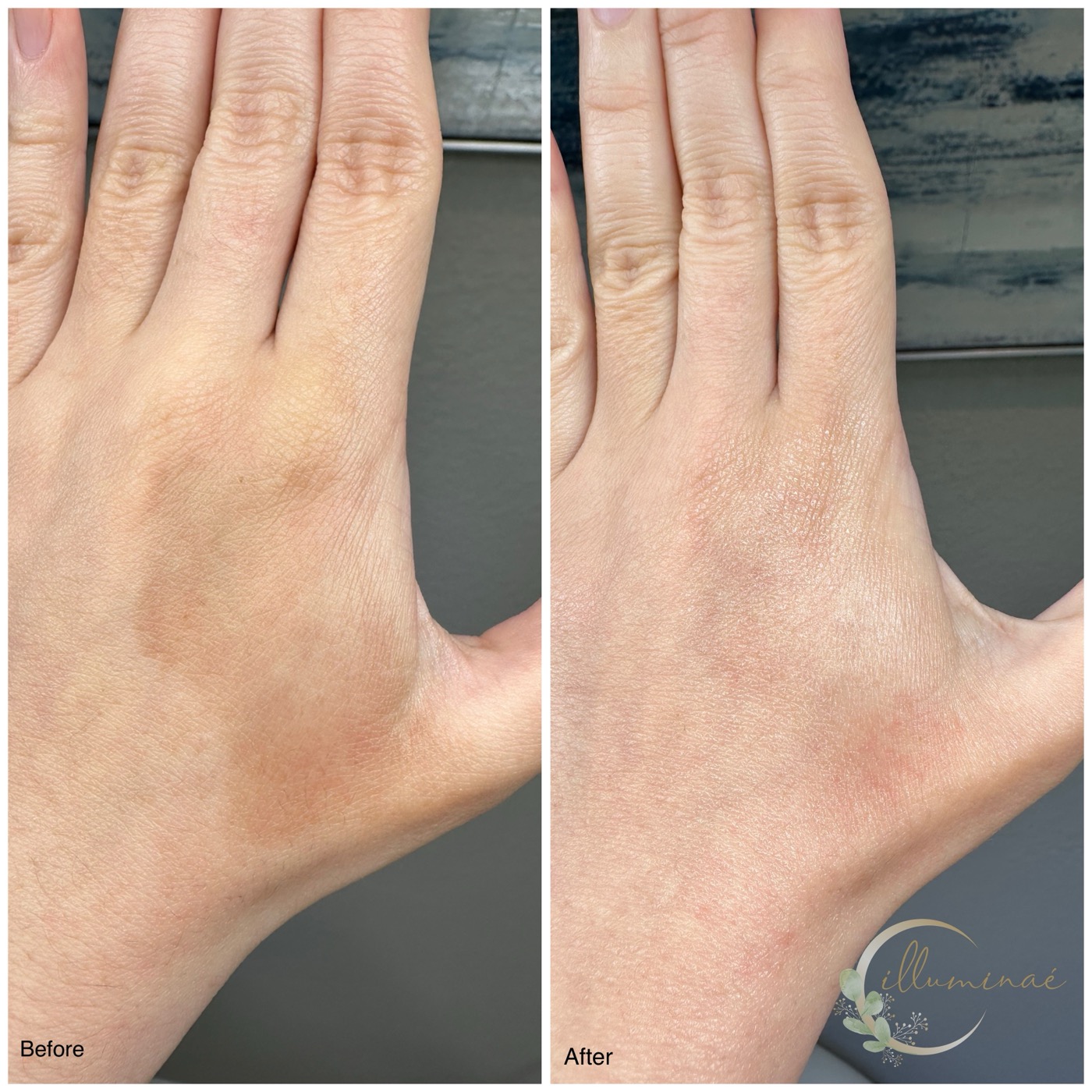 Before and after: hand treatment with reduction in sun damage