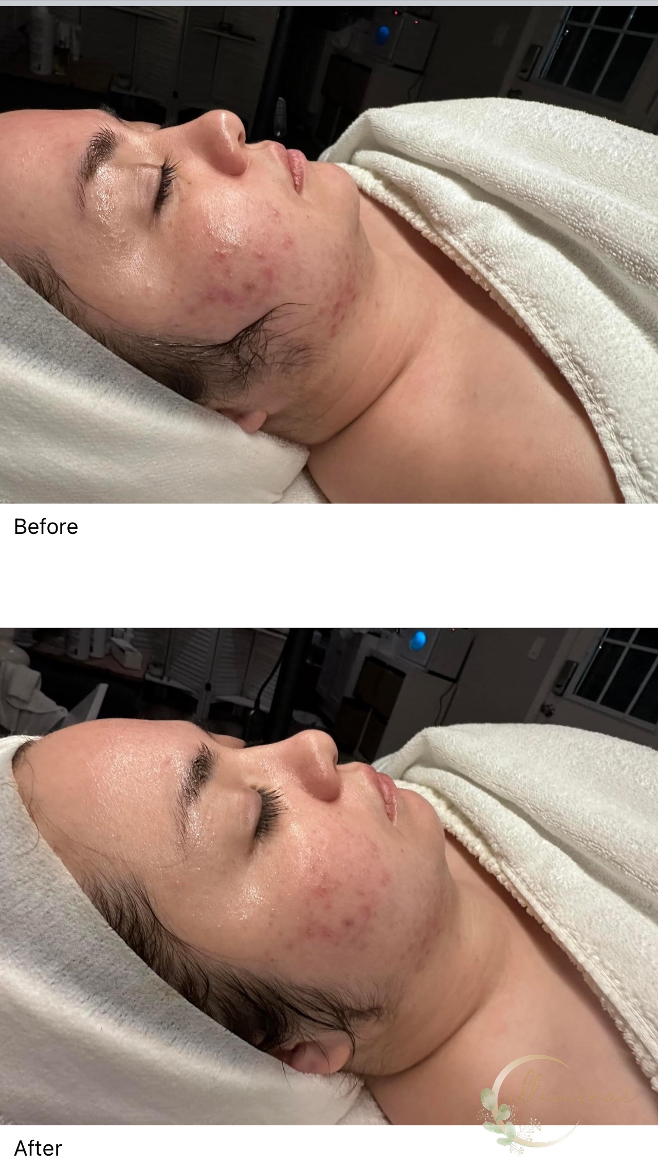 Before and after: acne and post-inflammatory marks