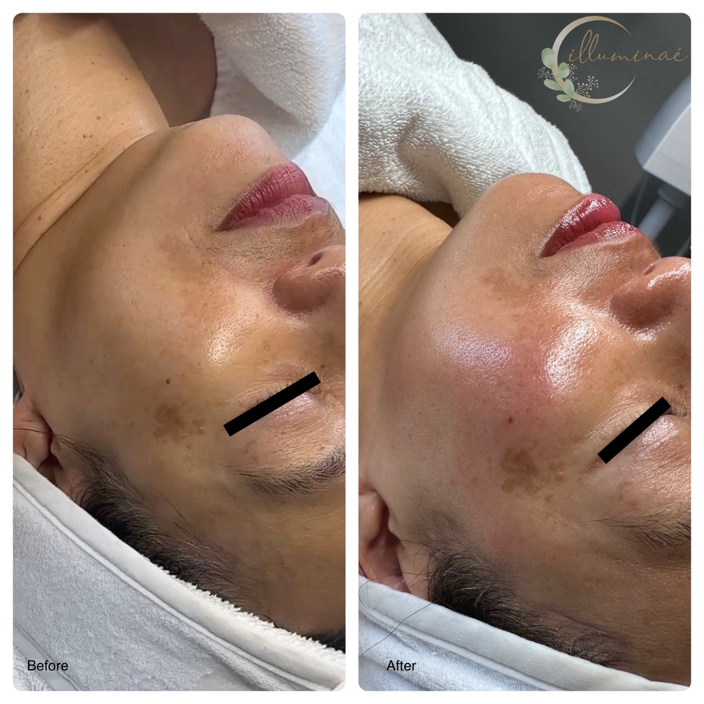 Before and after: melasma and skin tone improvement